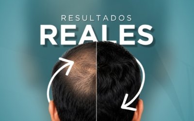 Recupera tu Cabello
